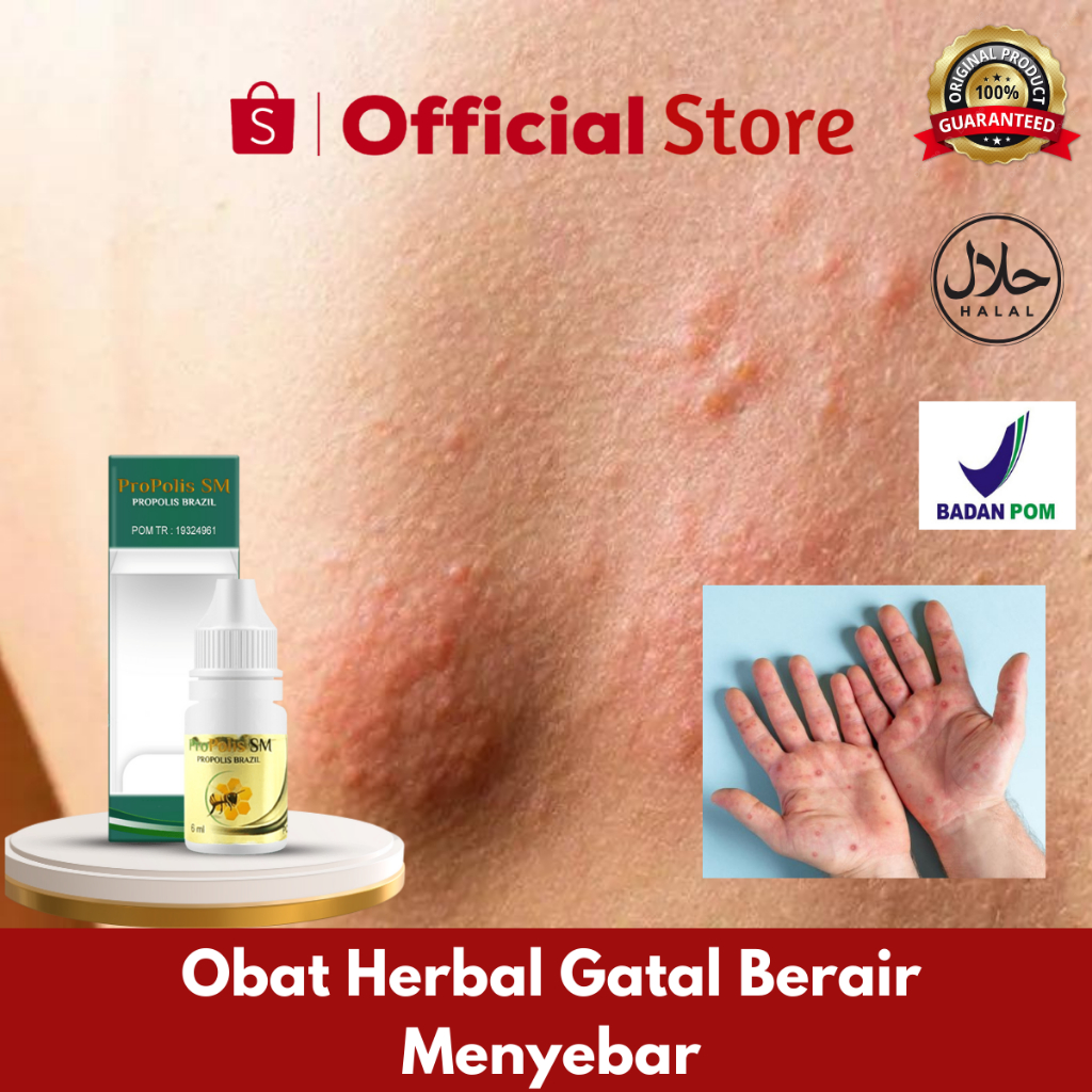 Obat Herbal Gatal Berair Menyebar, Obat Gatal Kulit, Obat Gatal Berair Di Jari Tangan Dan Kaki, Obat