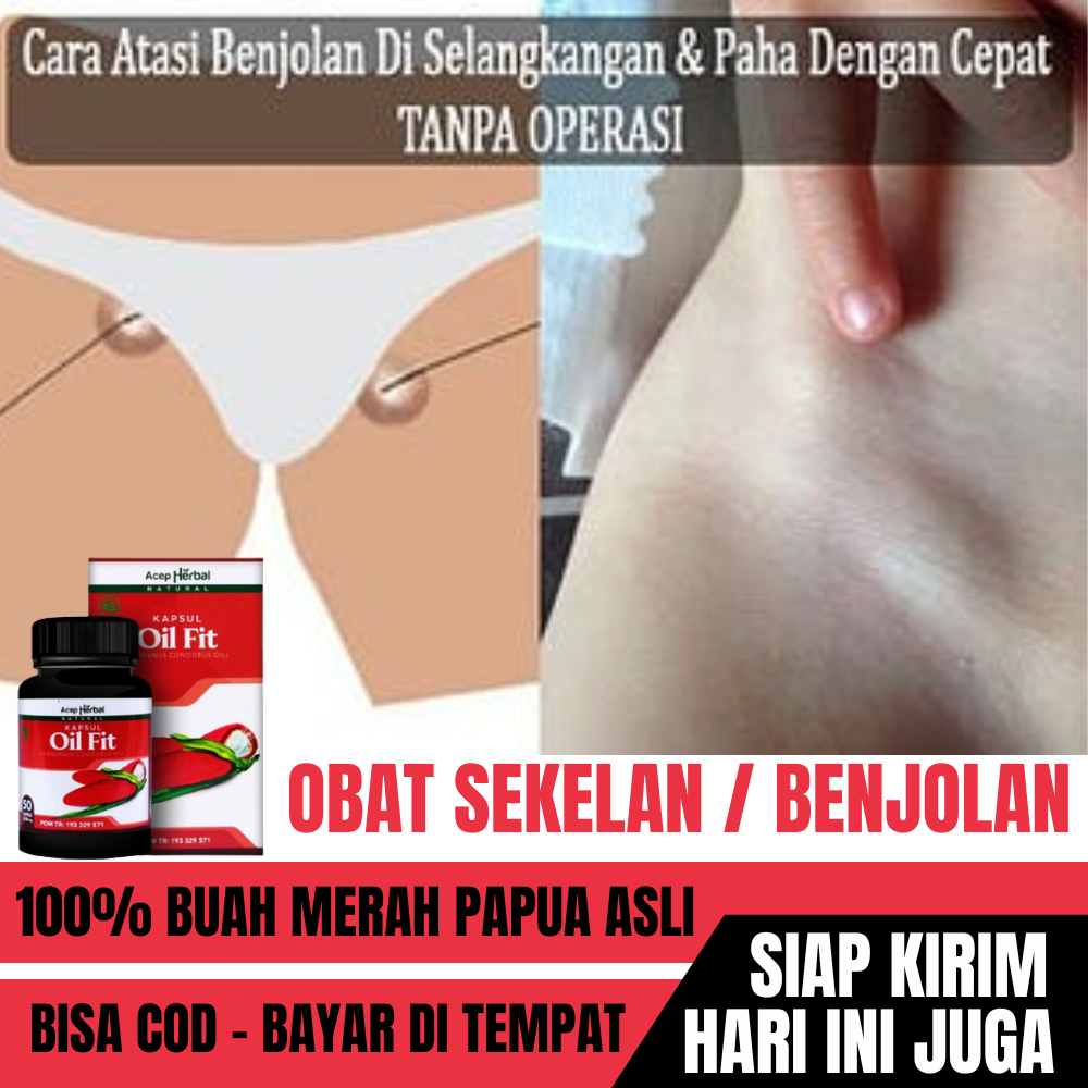 Obat Sekelan Kelenjar Getah Bening di Selangkangan, Benjolan di Paha, Obat Untuk Penghilang Sekelan,