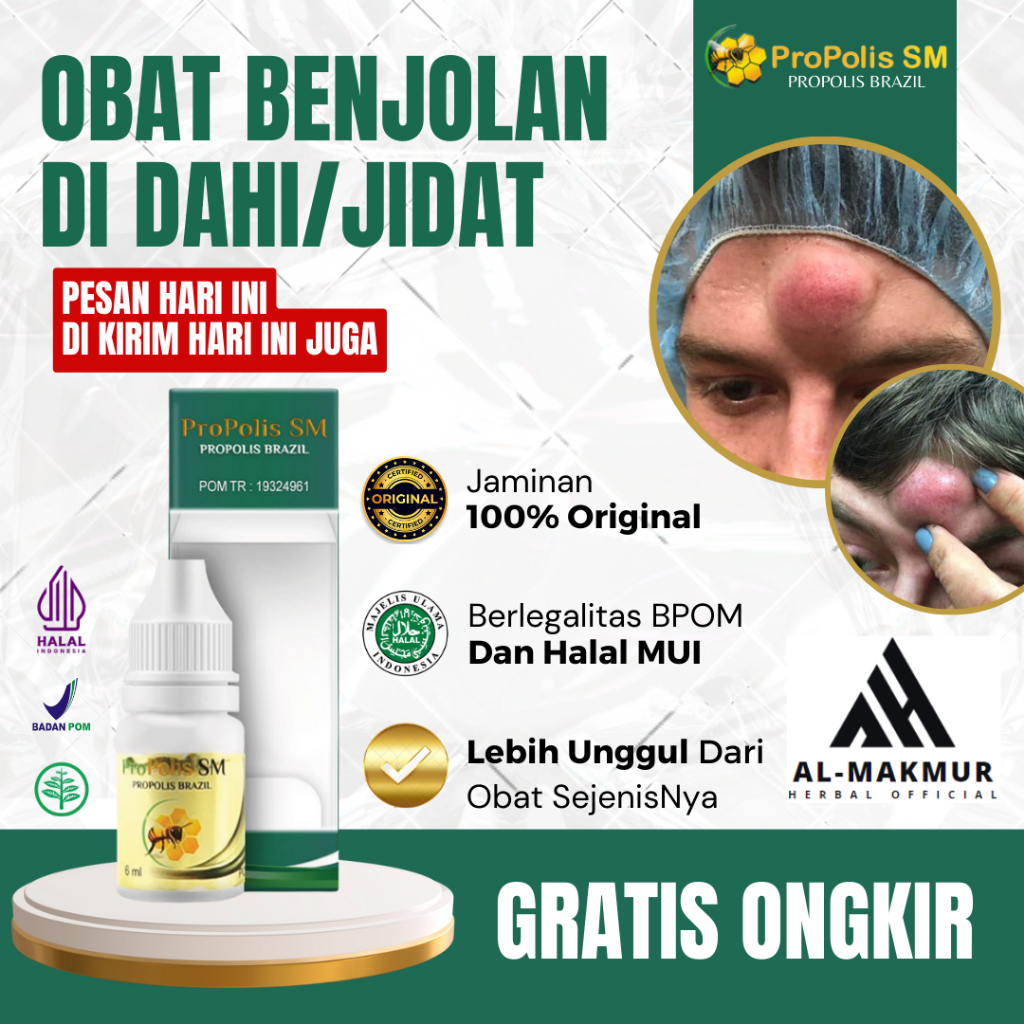 Obat Benjolan Di Dahi, Obat Benjolan Di Jidat Kiri Kanan, Obat Benjolan Di Kepala, Obat Benjolan Uci