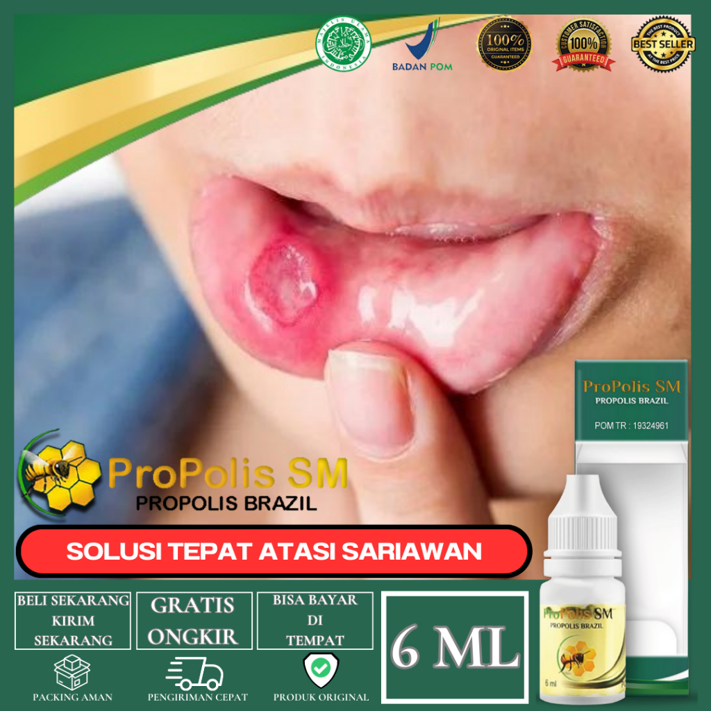 Obat Sariawan Bibir, Sariawan Mulut, Sariawan Lidah, Mucocele Pada Anak & Dewasa Propolis SM Brazil