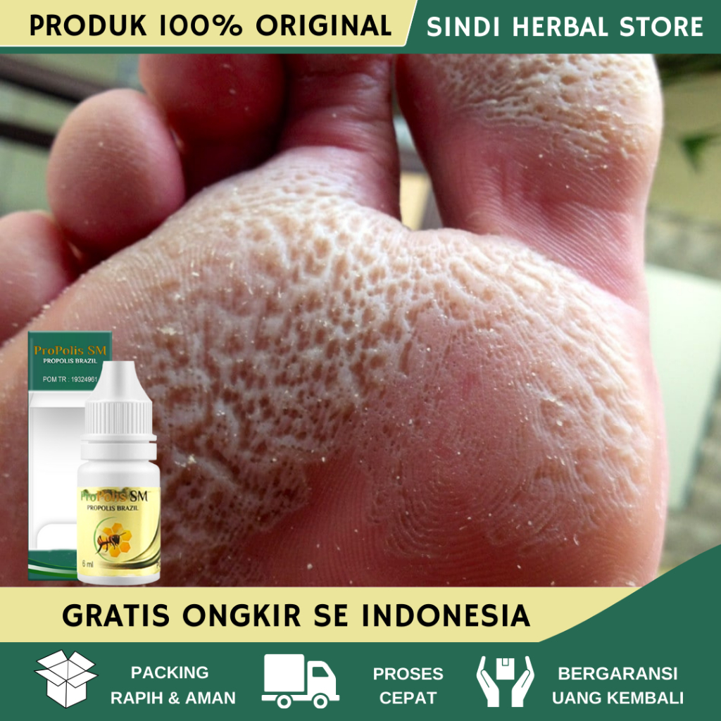 Obat Kaki Rayapan dan Bau, Obat Kaki Bolong-Bolong, Obat Oles Kaki Rayapan, Telapak Kaki Rayapan, Ro
