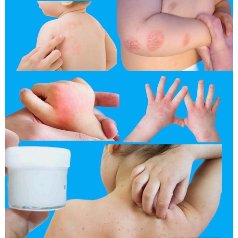 Salep Gatal Racikan Dokter Spesialis Untuk Anak