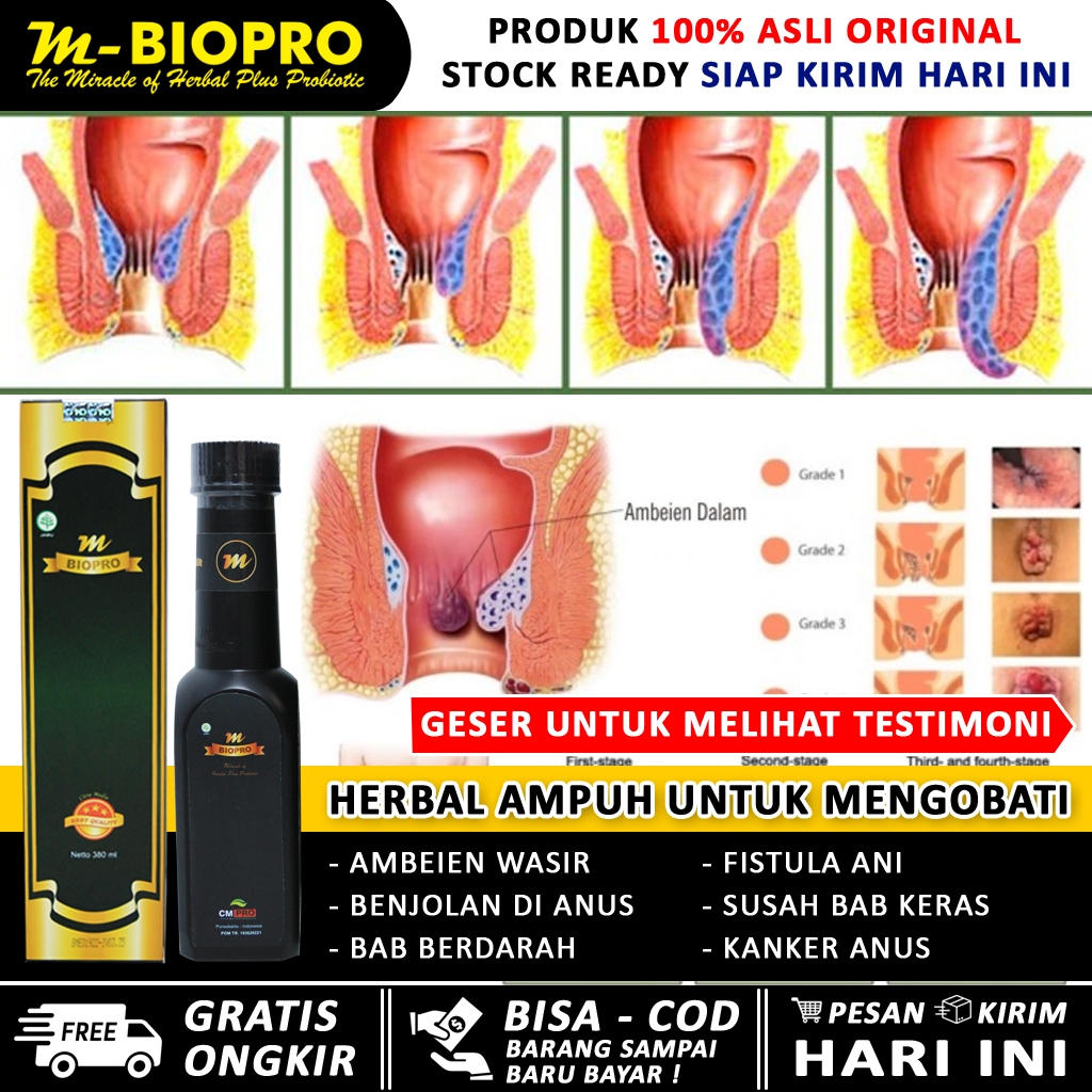 Obat wasir paling ampuh - obat wasir cina - obat ambeien stadium 3 dan 4 - BAB berdarah - duduk tida