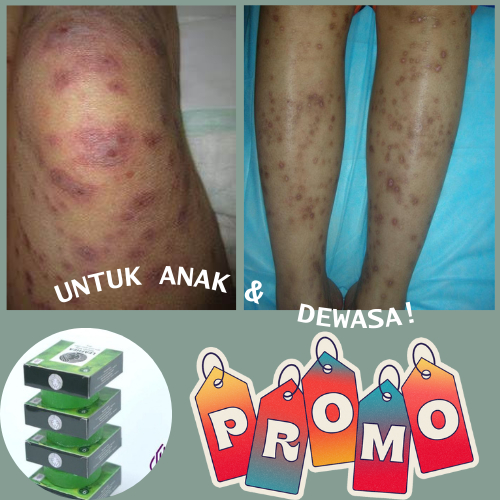 Obat Penghilang Bekas Luka Koreng, Obat koreng di Kaki, Pantat, Kepala, Obat Penghilang bekas luka G