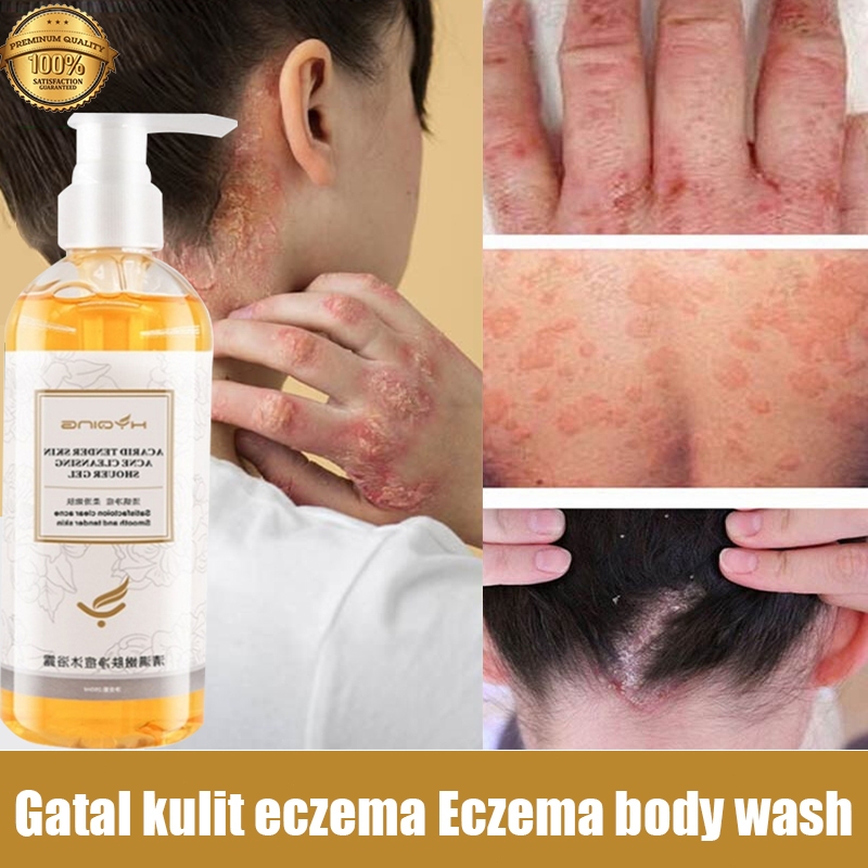 eczema body wash Pengobatan Eksim psoriasis eksim kering Kurap gatal kulit jamur kulit eksim lotion eksim bayi eksimer kuning Perawatan