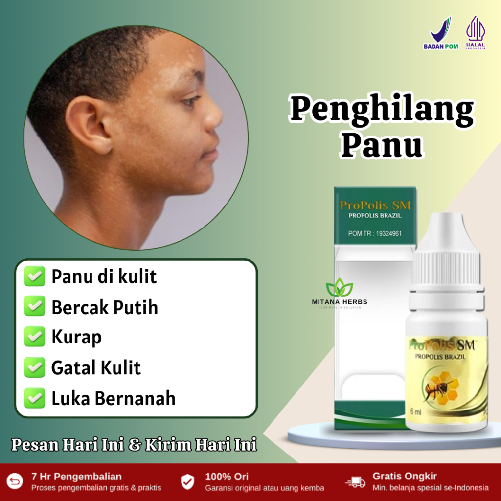 Obat Panu Anak Di Wajah, Penghilang Panu, Obat Jamur kUlit, Obat Panu Cair, Obat Panu Anak, Obat Pan