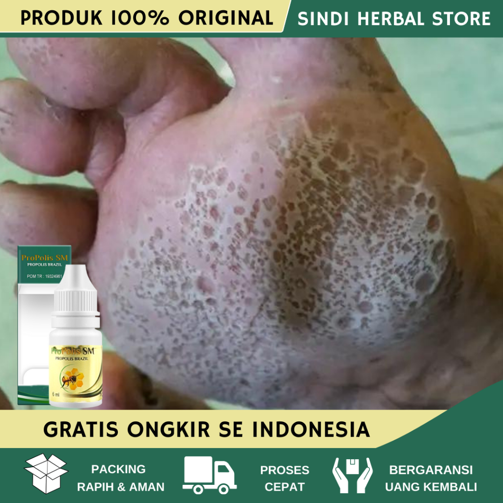 Obat Kaki Rayapan Obat Kaki Pecah2 Kering Parah Obat Penghilang Kapalan Mata Kaki Obat Kaki Rayapan 