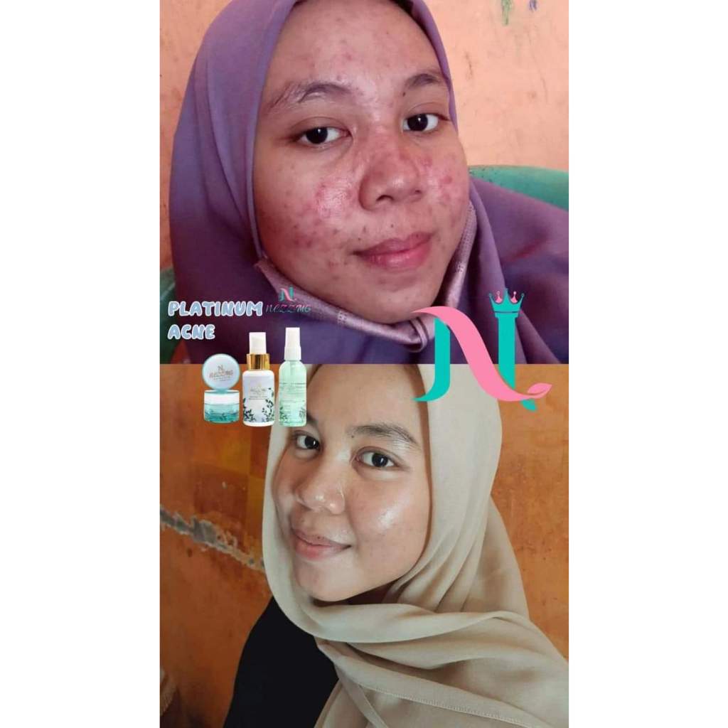 GARANSI UANG KEMBALI, NEZZMG SKINCARE PLATINUM SERIES !! 2X LEBIH CEPAT, CREAM JERAWAT