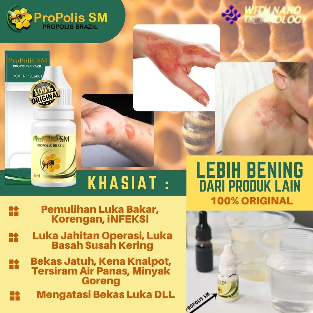 Obat Luka Bakar Minyak Panas, Obat Luka Bakar Air Panas, Obat Luka Bakar Kena Kenalpot, Obat Luka Ba