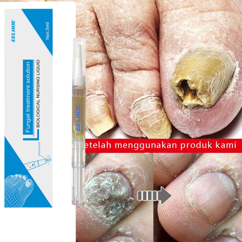 Nail repair serum perawatan kuku jamur rusak dan cantengan kaki tangan Obat Jamur Kuku Kaki Obat Kuk