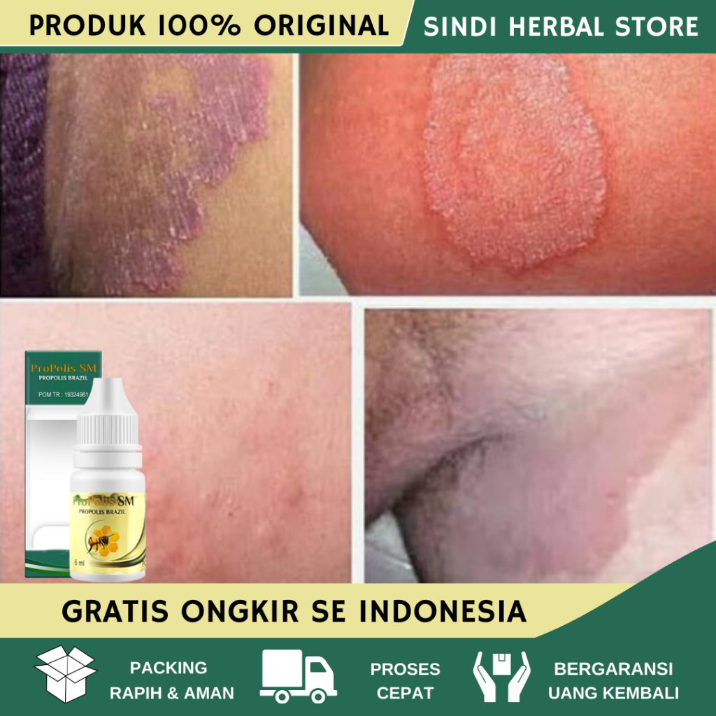 Obat Selangkangan Hitam, Obat Gatal Selangkangan, Selangkangan Lecet, Exim Selangkangan, Penghilang 