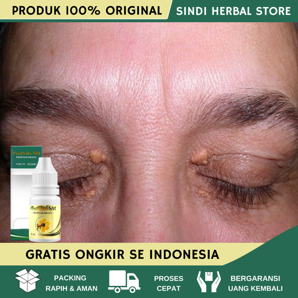 Obat Xanthelasma, Obat Herbal Mata Xanthelasma, Obat Penghilang Xanthelasma, Obat Syringoma, Penghil