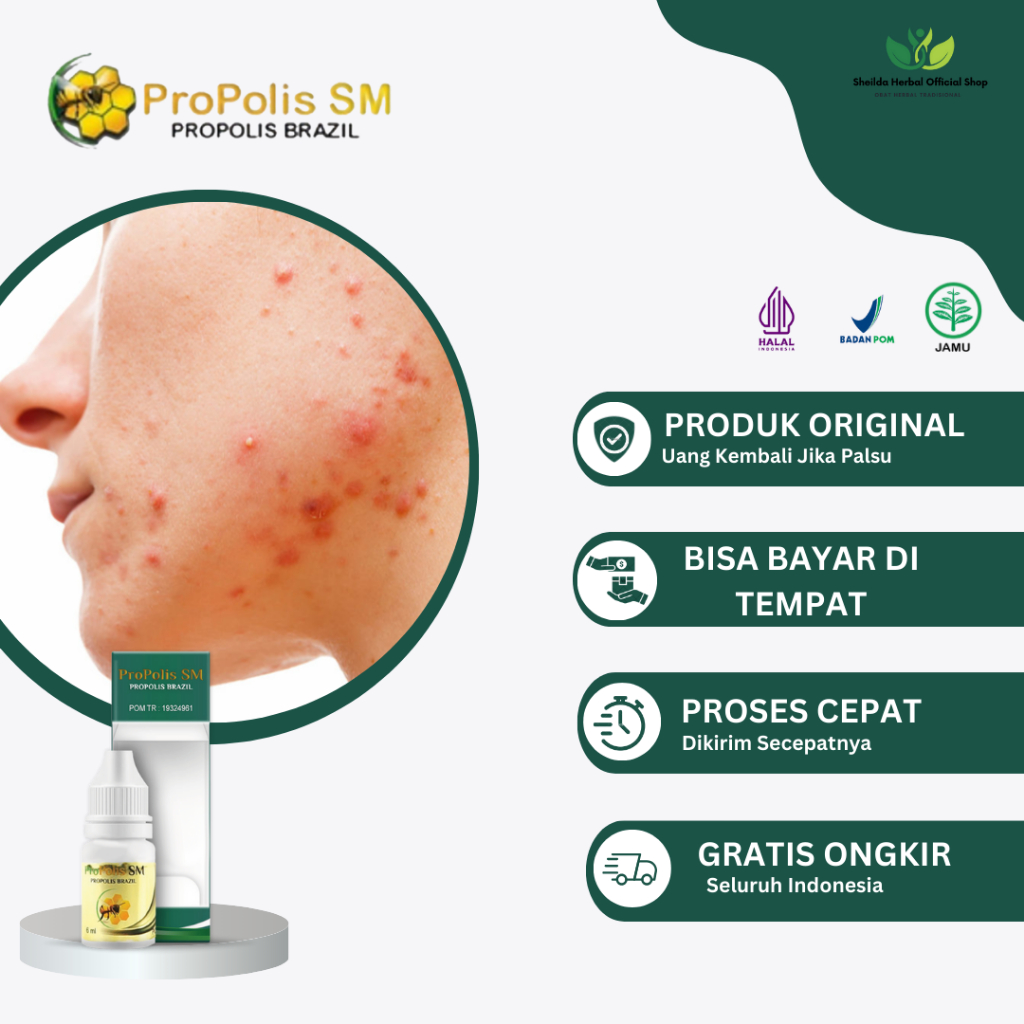 Propolis SM Mengatasi Jerawat Batu, Pembersih Jerawat Di Pipi, Dagu, Jidat, Bintik Hitam Bekas Jeraw