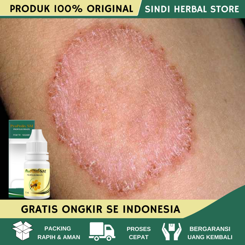 Obat Selangkangan Hitam, Obat Gatal Selangkangan, Salep Gatal Selangkangan, Obat Gatel Selangkangan,