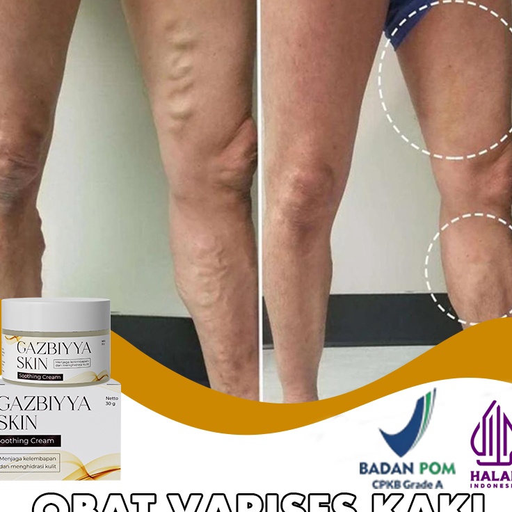 STOK SIAP COD Obat varises kaki valesin obat varises original salep varises obat varikokel 3g salep 