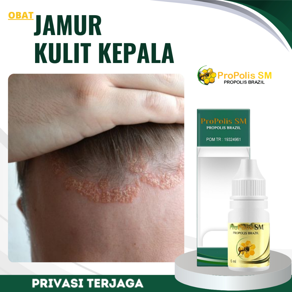 Obat Jamur kulit Kepala, Obat Jamur Kurap Kepala, Obat Infeksi Jamur Kepala, Obat Kulit Kepala Bersi