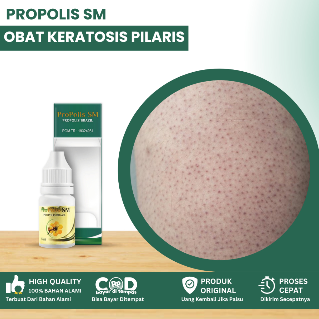 Obat Keratosis Pilaris, Obat Penyakit Kulit Ayam, Obat Keratosis Seboroik, Obat Kulit Gatal Terasa K