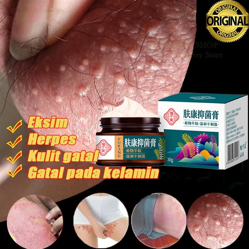 [100% Original] Salep gatal paling ampuh  psoriasis Obat Gatal Di Pantat UNTUK ALERGI GATAL Jamur JE
