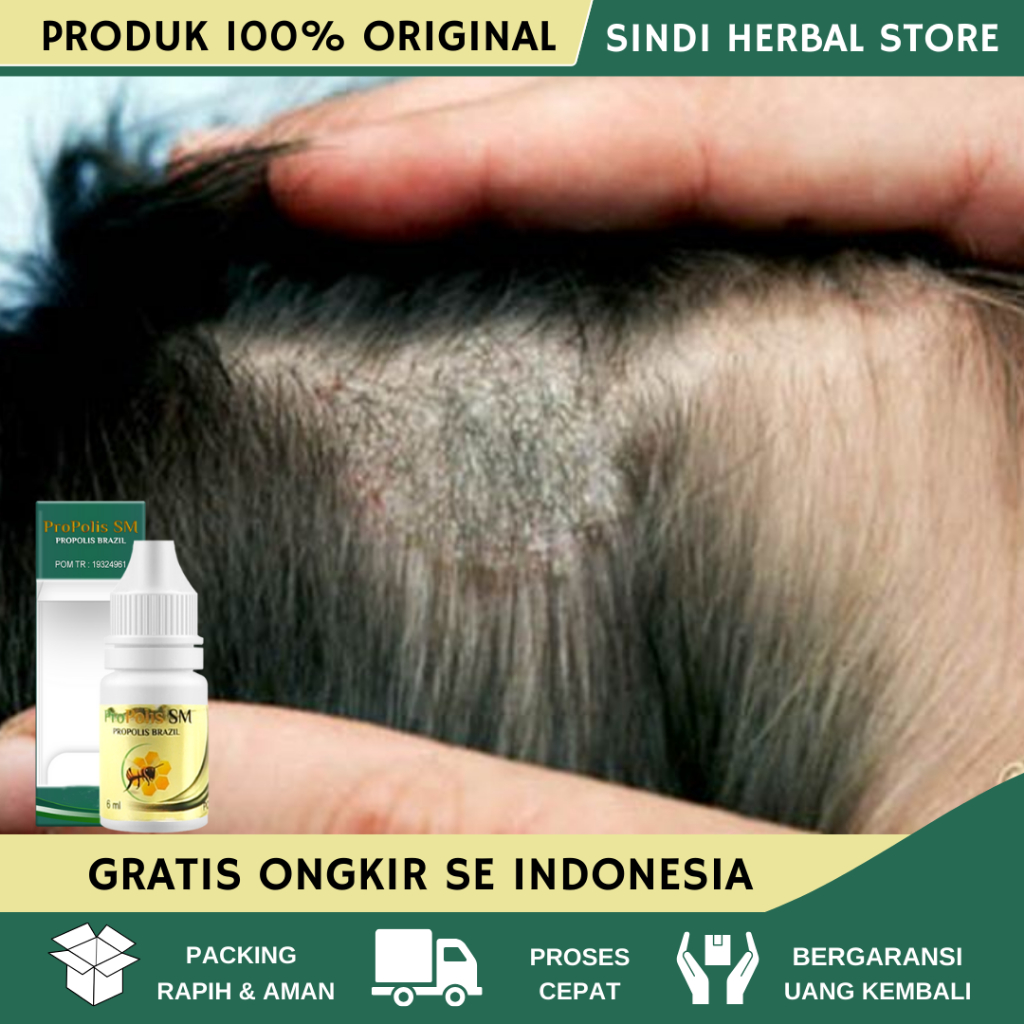 Obat Jamur Kepala, Obat Herbal Kepala Berkerak, Obat Penghilang Kerak di Kepala, Obat Infeksi Jamur 