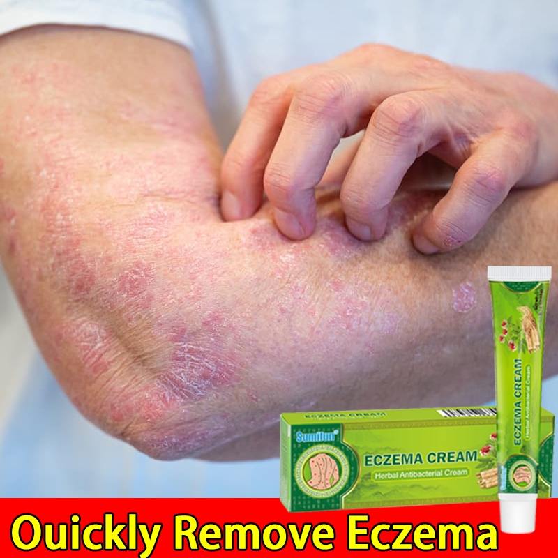 Salep gatal paling ampuh salep gatel Salap gatal kulit yang ampuh obat gatal kulit Salep cina obat g