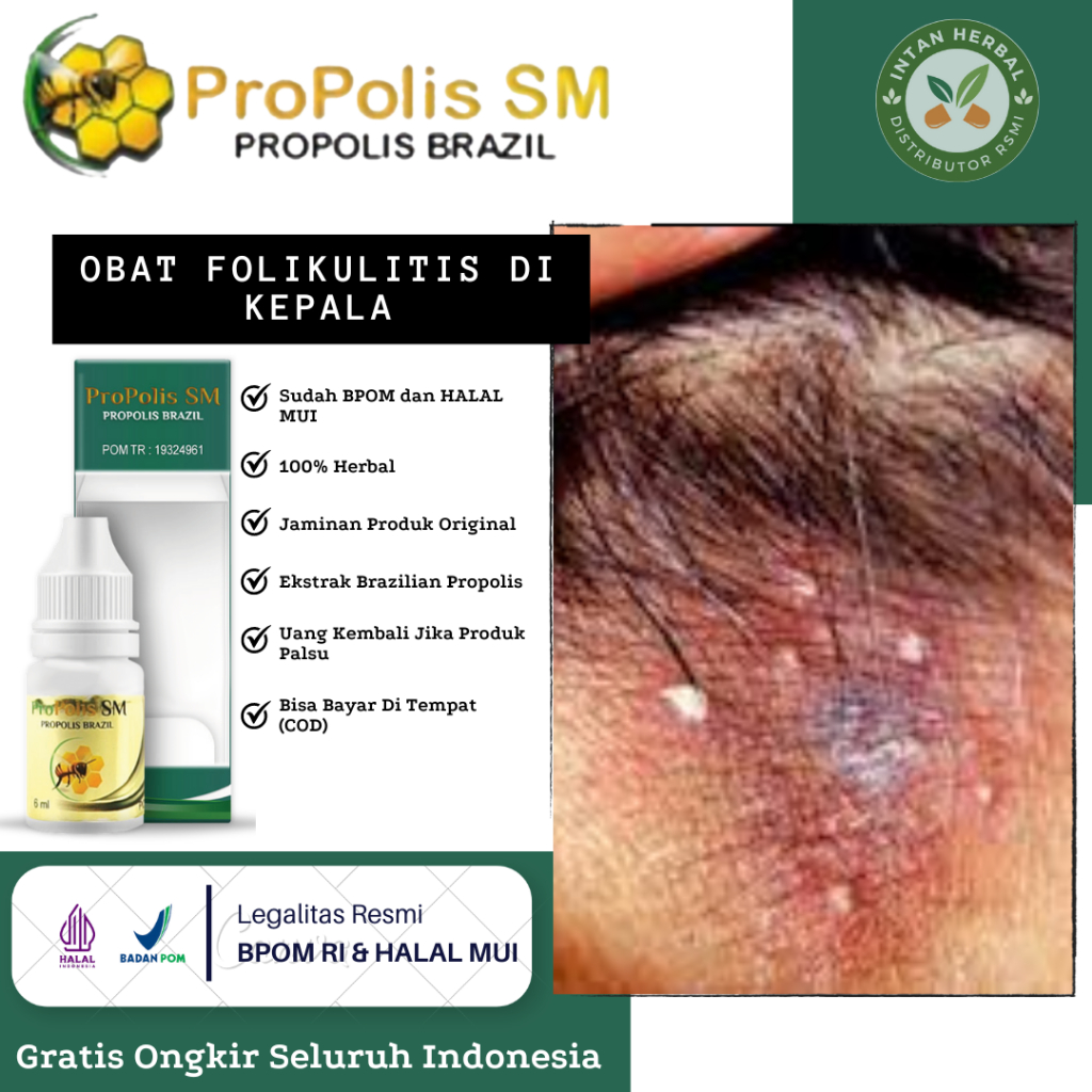 Obat Folikulitis di Kepala, Borok di Kulit Kepala, Jamur Kulit Kepala, Benjolan Folliculitis, Luka d
