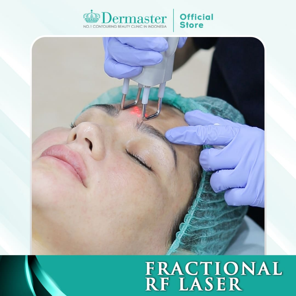 Dermaster Fractional RF Laser Treatment