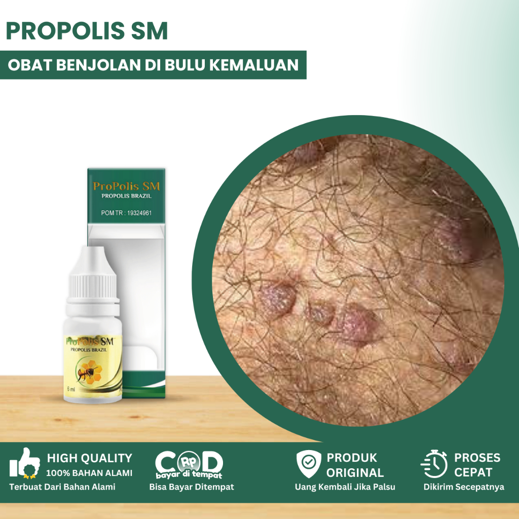 Obat Benjolan Di bulu Kemaluan, Obat Gatal Jamur Kulit Di Bulu Kemaluan, Obat Pengempes Benjolan Kel