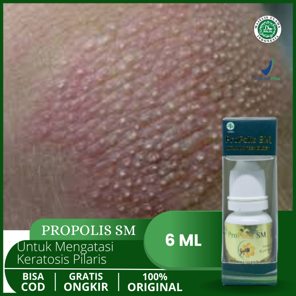 Obat Keratosis Pilaris, Penyakit Kulit Ayam, Penghilang Bintik Pada Kulit, Benjolan Keratosis Pilari