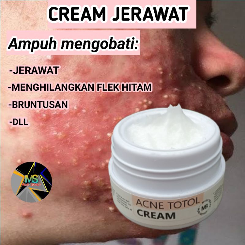 MOISTURIZER SALEP JERAWAT DAN BEKAS JERAWAT |  JERAWAT BATU  PALING AMPUH | APOTIK 12,5 GRAM WANITA