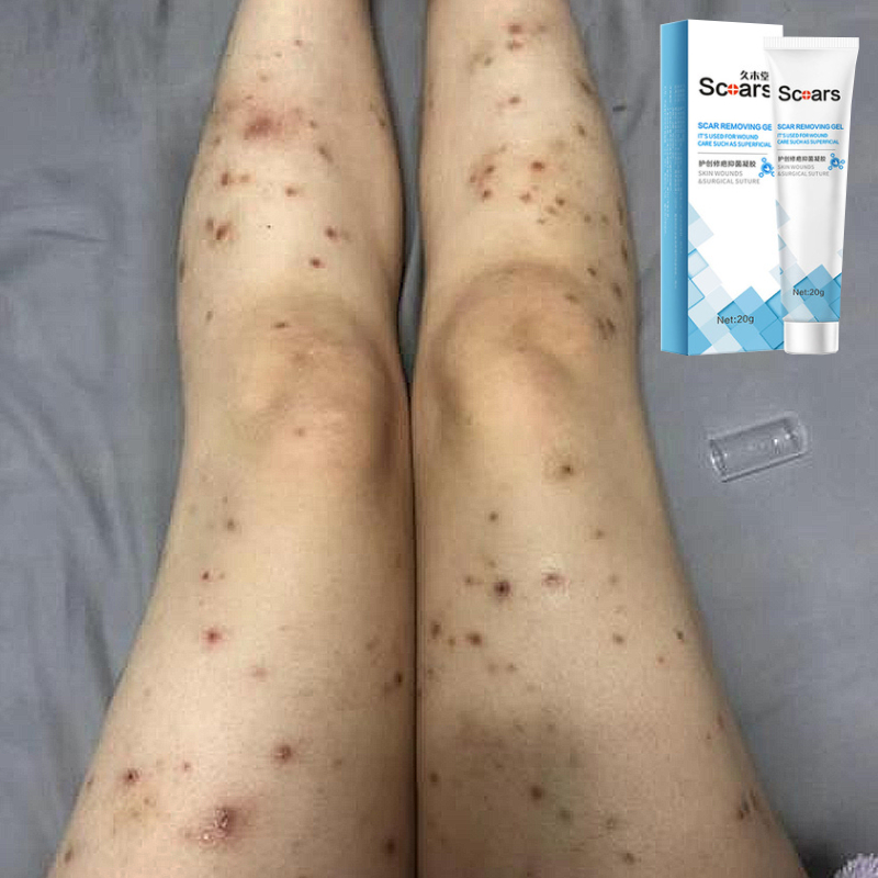 penghilang bekas luka penghilang bekas luka hitam koreng obat keloid penghilang bekas luka bakar pen