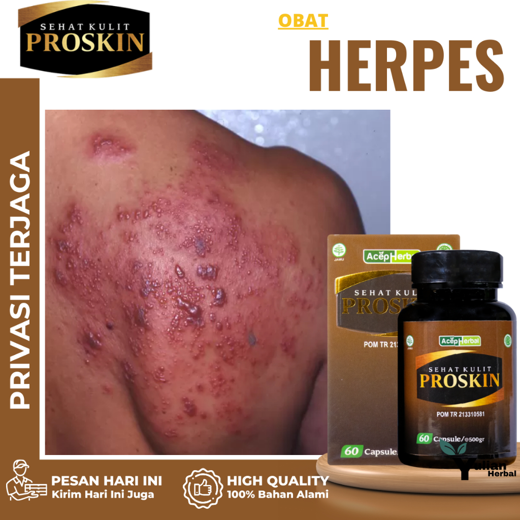 Obat Herpes Zoster, Obat Herpes kulit,Obat Herpes Genital, Obat Herpes Kelamin, Obat Penghilang Beka