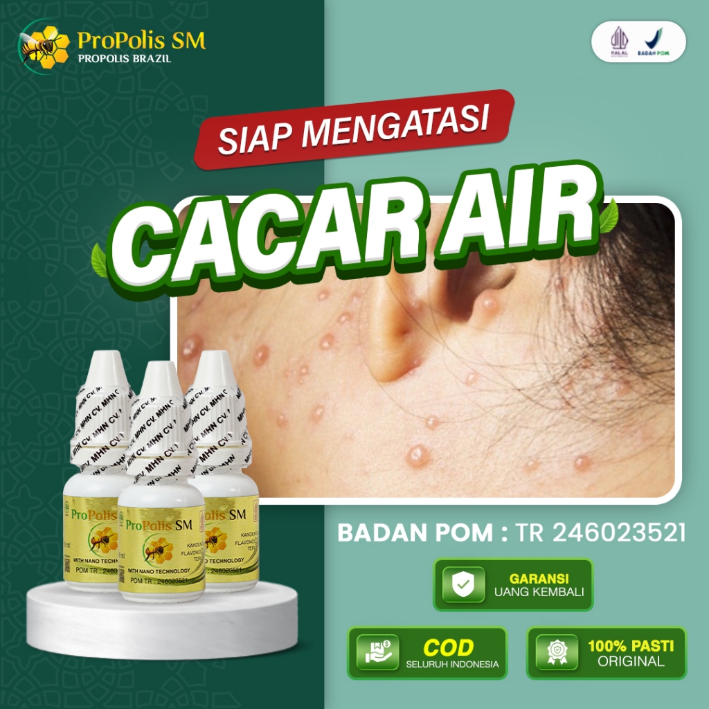 Obat Cacar Air Ruam Merah Kulit Melepuh Bentol Gatal Gatal Untuk Anak & Dewasa Propolis SM Original
