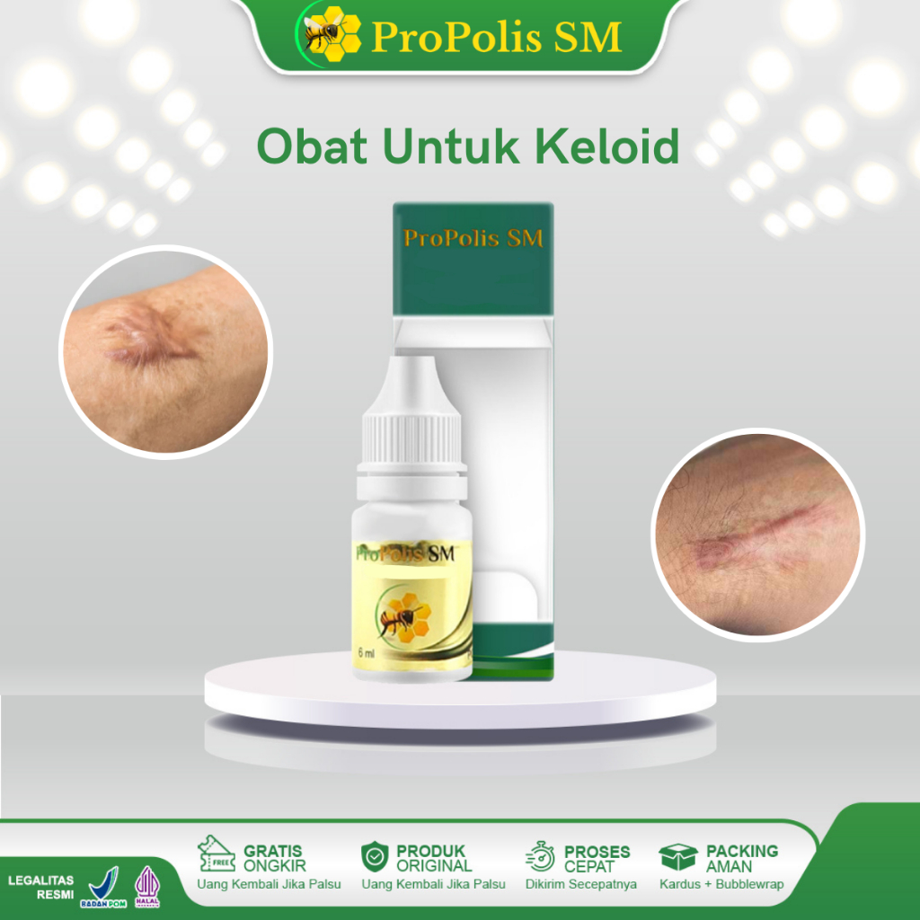 Obat Tetes Keloid Menahun Benjolan Keloid Luka Keloid Menonjol Keloid Daging Tumbuh Keloid Berkerut 