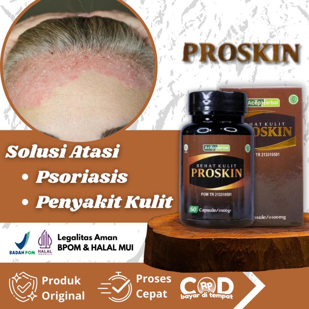 Obat Psoriasis, Gatal Kulit Psoriasis, Psoriasis Kulit Kepala, Kulit Bersisik Dan Tebal, Gatal Kulit