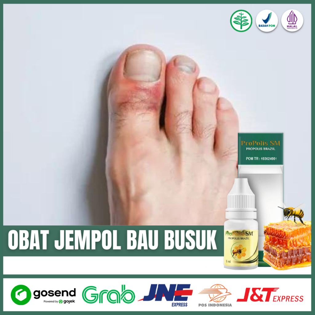 Obat Jempol kaki Bau Busuk jempol Bau Busuk Herbal Kaki Bau Busuk Jempol Bau Propolis SM di surabaya