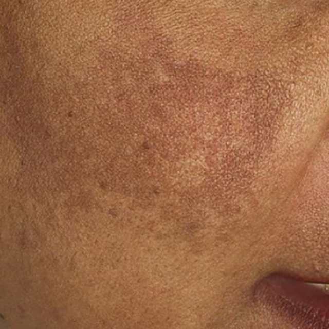 Luxury injeksi Melasma Promo