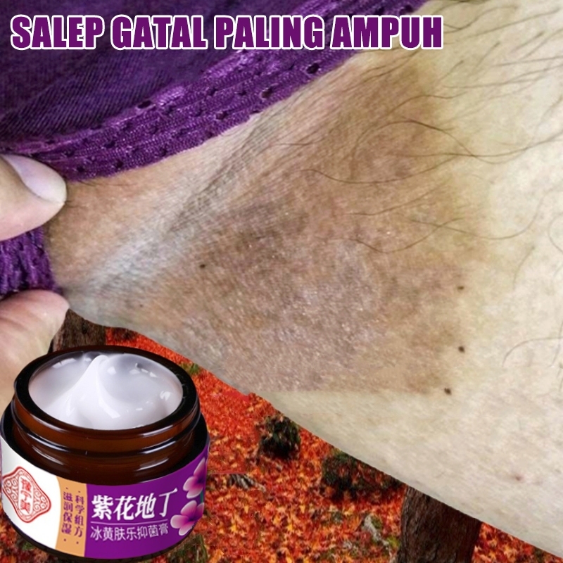 【100%Ori】Salep gatal paling ampuh obat gatal selangkangan obat gatal paling ampuh 30g Salep gatal se