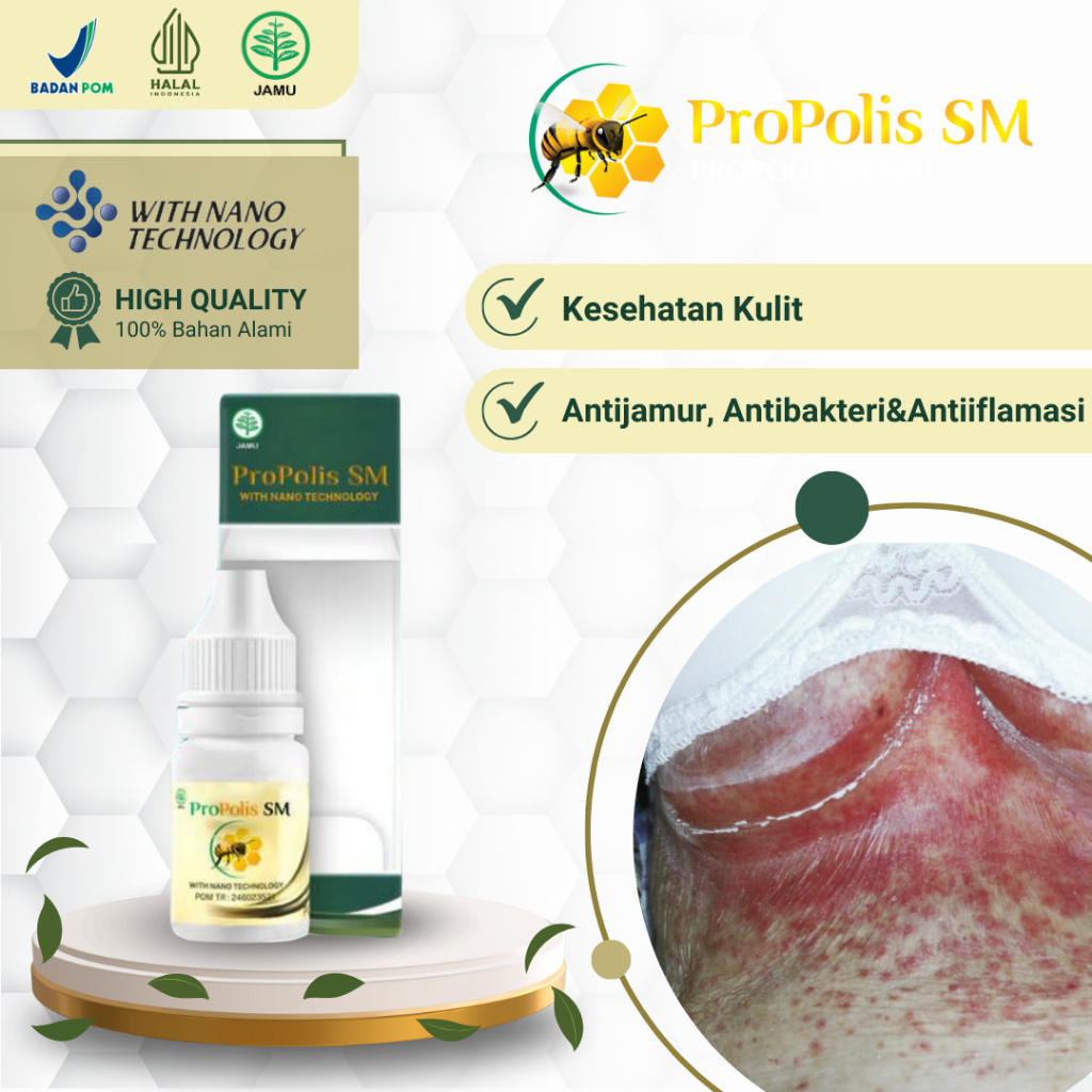 Obat Lecet Gatal Lipatan Payudara, Obat Iritasi Di Dilipatan Payudara, Obat Infeksi Jamur Payudara, 