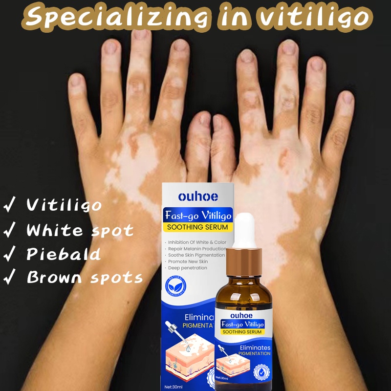 Pengobatan Vitiligo obat vitiligo ampuh /protopic Vitiligo alep vitiligo, panu, biang keringat, sale