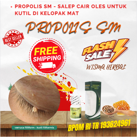 PROPOLIS sm - Salep Cair Oles Untuk kutil di kelopak mata, obat penghilang kutil di kelopak mata, me