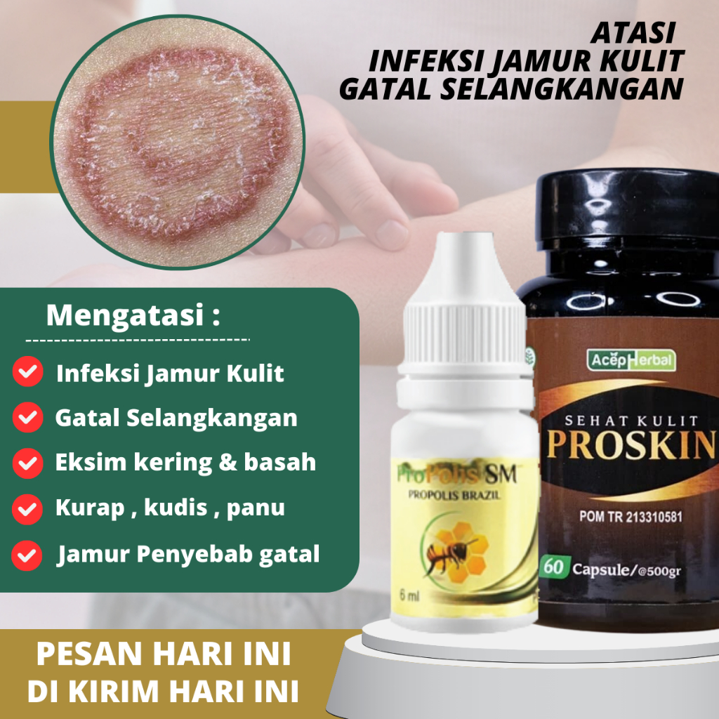 Obat Jamur Dermatitis Psoriasis Eksim Jamur , Obat Infeksi Jamur Gatal, Obat Gatal Kulit, Salep Eksi