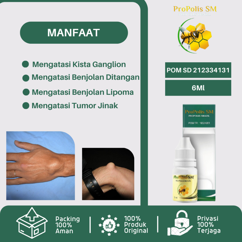 Obat Kista Ganglion Benjolan Ganglion Benjolan Di TanganMengecilkan Kista Ganglion Penghilang Benjol
