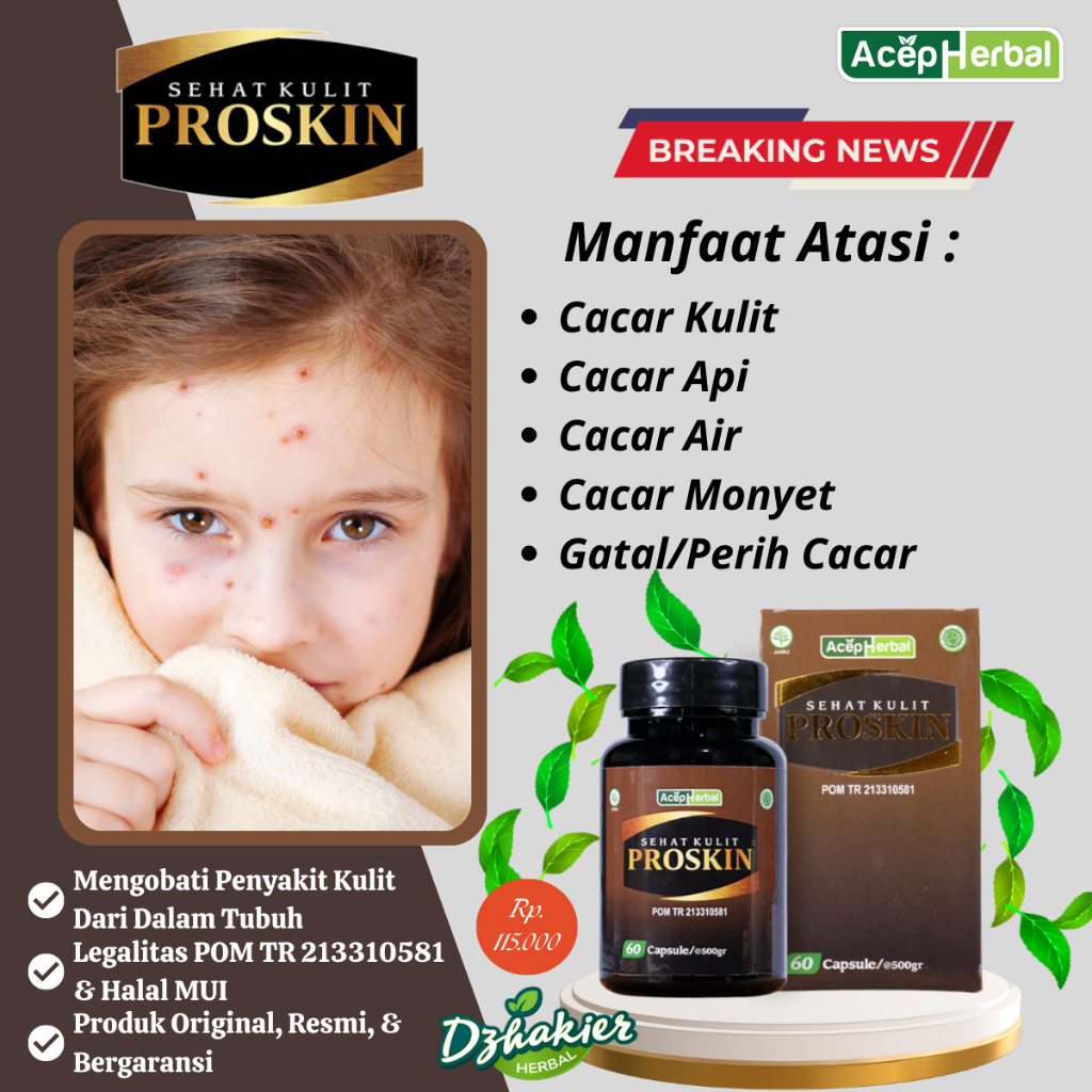 Obat Cacar Kulit, Cacar Monyet, Cacar Api, Cacar Air, Gatal Dan Perih Cacar Atasi Dengan Sehat Kulit