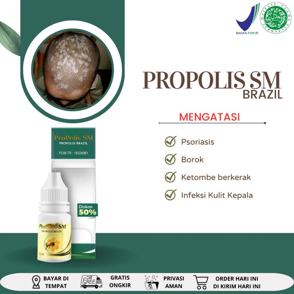 Obat Tetes Ketombe, Obat Kulit Kepala Berkerak, Kering Gatal, Bersisik, Koreng, Obat jamur kulit Kep