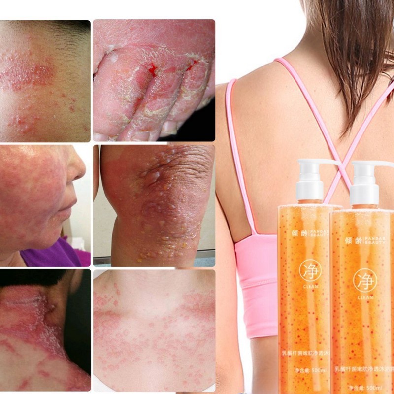 Eczema body wash Sabun Mandi Pemutih Sabun Gatal shower gel untuk perawatan eksim psoriasis menghila