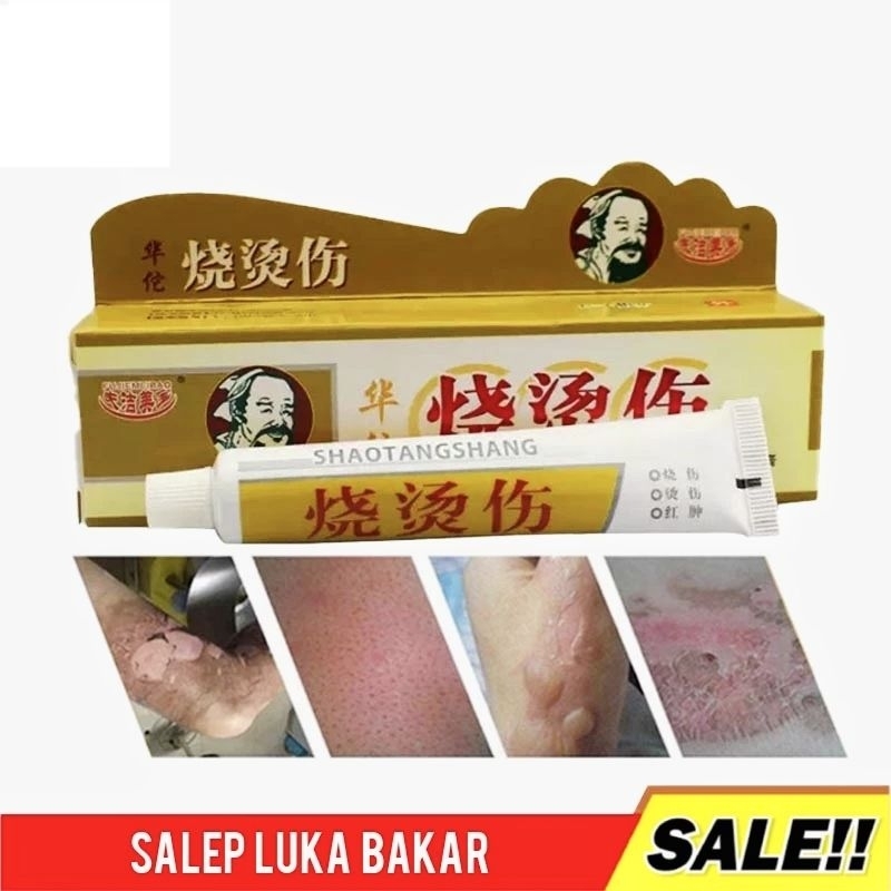 SALEP CINA LUKA BAKAR PALING AMPUH