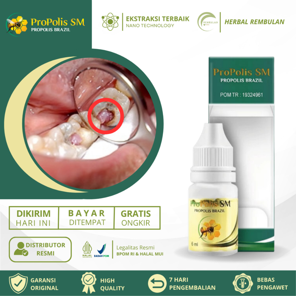 Obat Polip Pulpa Gigi, Obat Polip Gigi Benjolan Gusi, Sakit Gigi Berlubang, Obat Benjolan Di Gigi Be