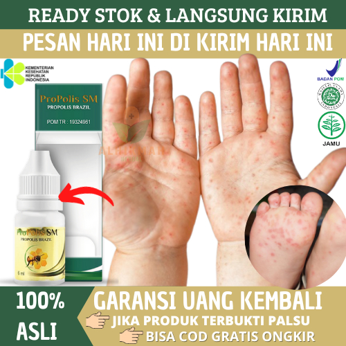 Obat Kutu Air Di Tangan, Obat Kutu Air Di Jari, Obat Kutu Air Di Kaki, Obat Kutu Air Telapak Kaki, O