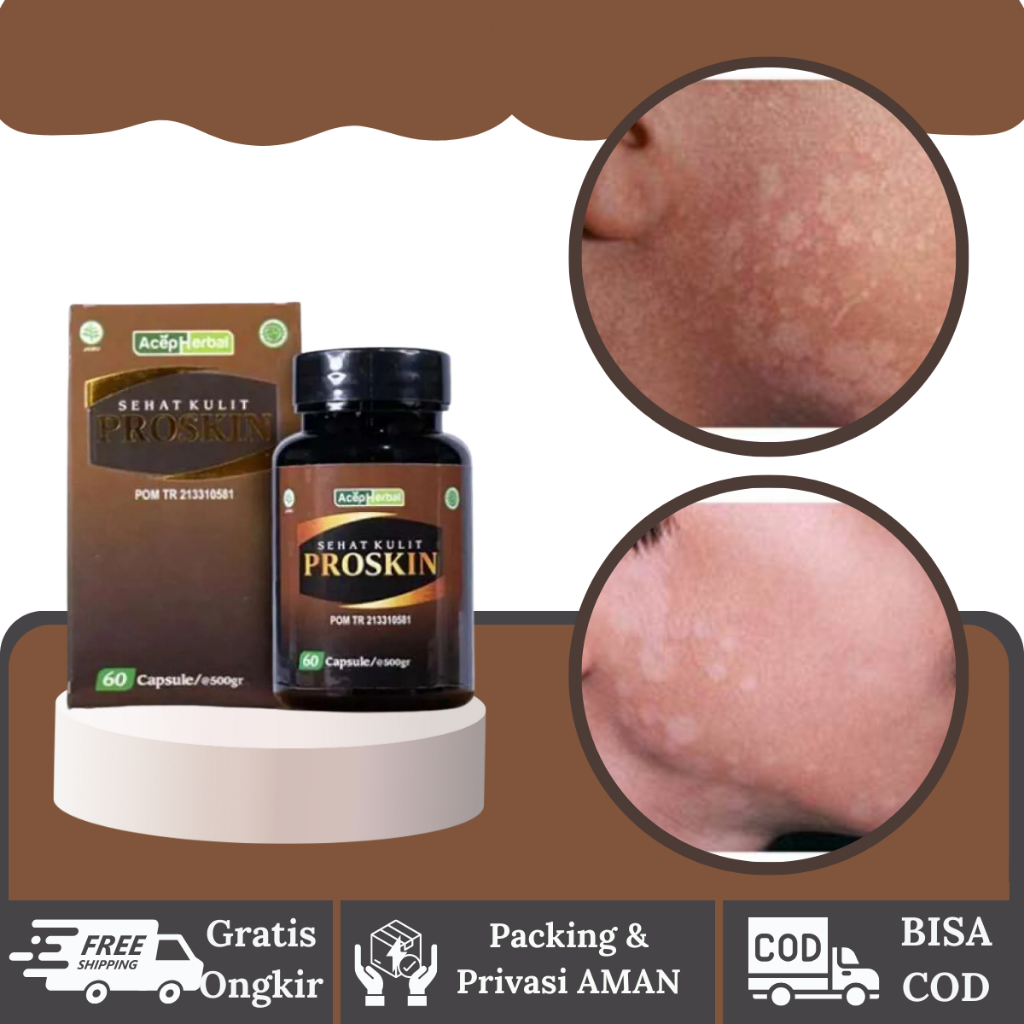 Herbalthy - Obat Penghilang Balas Bogo - Obat Penghilang Panu / Hapur - Proskin 60 Kapsul