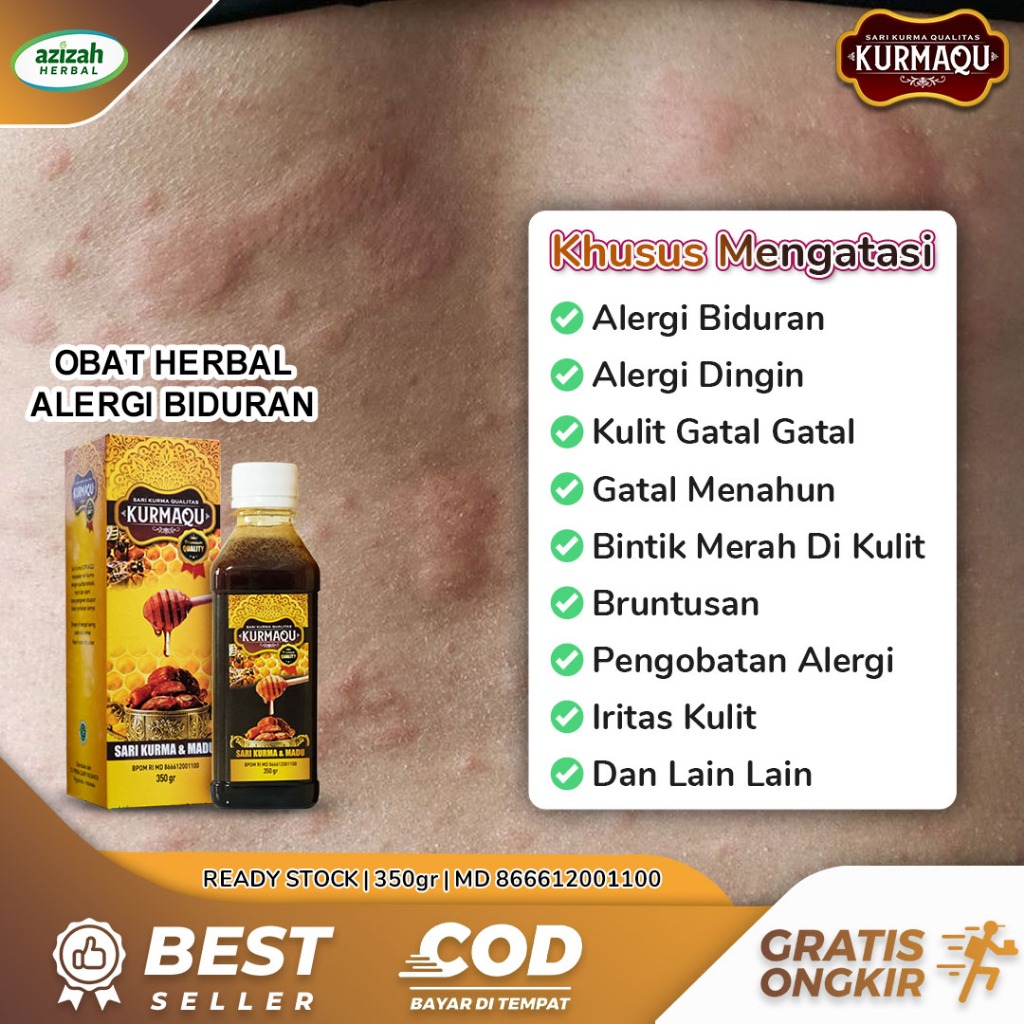 Obat Alergi Dingin Biduran Kaligata Gatal Gatak Menahun Bintik Merah Di
Kulit Bruntusan Herbal Kurmaqu Dan Madu Asli